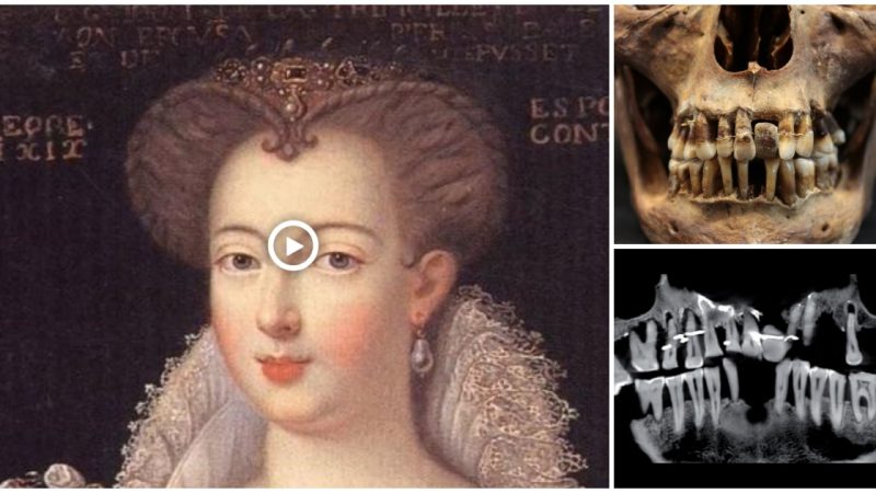 17th-century Frenchwoman’s ‘innovative’ gold dental work was likely torturous to her teeth