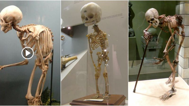 Early Human Skeletal Abnormalities Occurred ‘Abundantly’