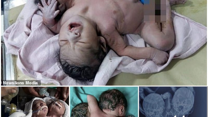 A newborn baby with two heads, three arms, and two hearts shocked the online community, and the mother cried without words when she gave birth to two babies.