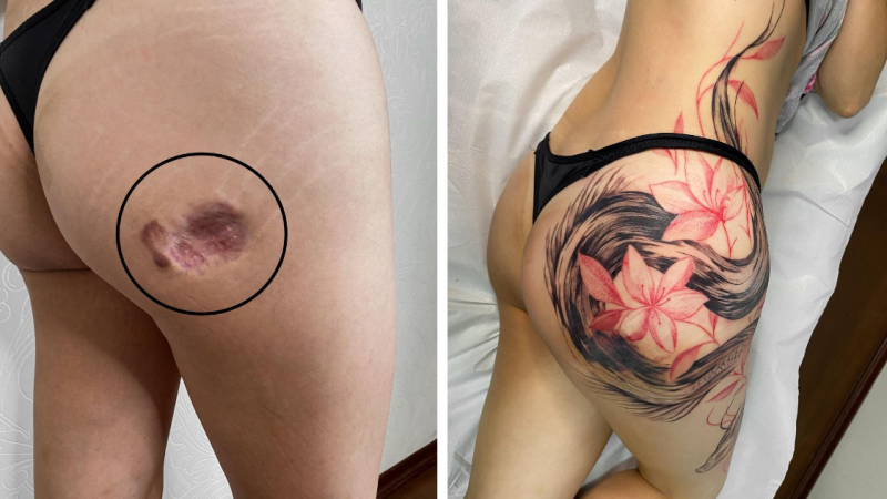 13 Perfect Transformations Of Scars Into Works Of Art Through Tattoos