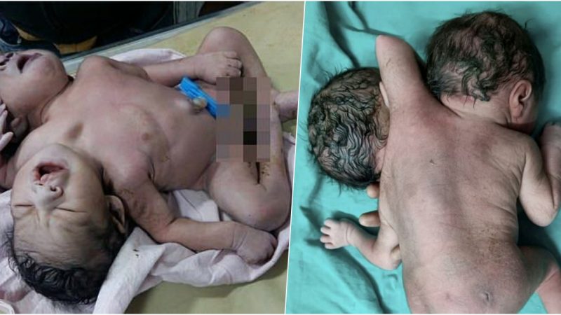 A newborn baby with two heads, three arms and two hearts shocked the online community and the mother cried without words when she gave birth to 2 babies