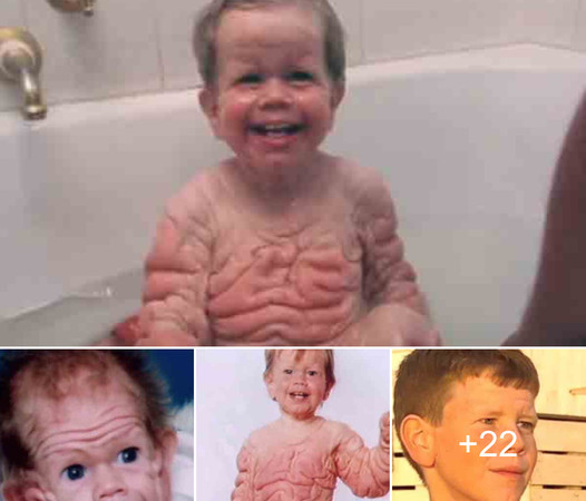 Extraordinary Infant Born with Skin Resembling that of a 70-Year-Old Person