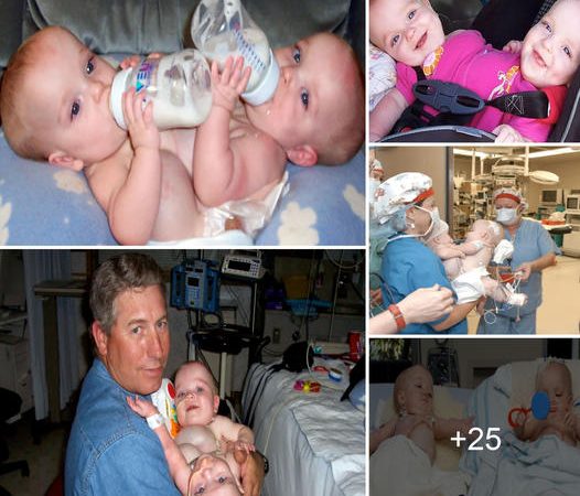 A Remarkable Story of Mackenzie and Macy Garrison – Uncommon Conjoined Twins Born to Triplet Siblings