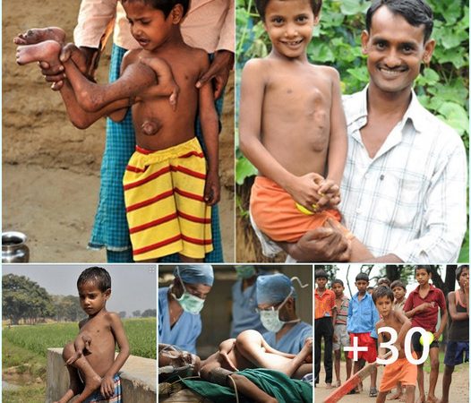 A Miraculous Metamorphosis: The Unbelievable Transformation of a Boy with Four Legs and Four Arms