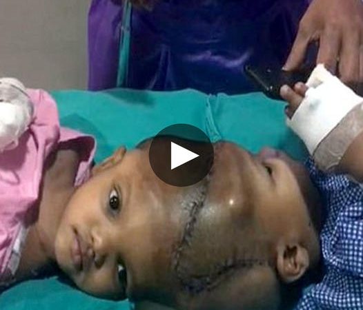 Miraculous Separation of Conjoined Twins Jaga and Kalia: A Tale of Unbreakable Bond and Hope