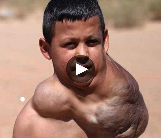 Defying the Odds: A Ten-Year-Old’s Triumph Over a Massive Neck Tumor