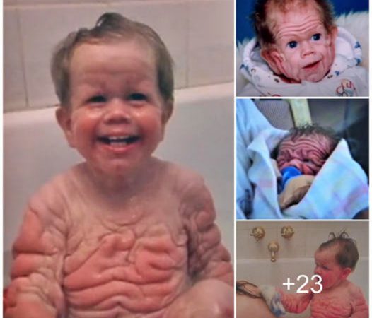 Tomm’s Extraordinary Journey: Triumph Over Rare Skin Condition